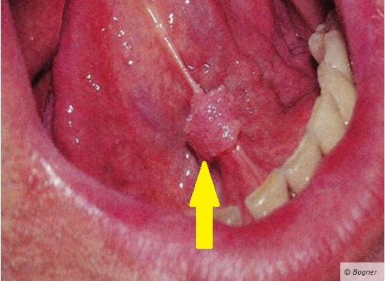 virus de papiloma tipos schimbare gazdă rotundă