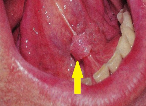 Papillomavírus zunge,